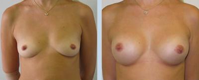 фото до и после увеличения груди, пластический хирург Салиджанов Анвар Шухратович