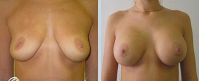 фото до и после увеличения груди, пластический хирург Салиджанов Анвар Шухратович