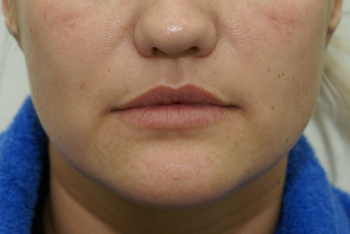 Фото до увеличения губ, пластический хирург Салиджанов Анвар Шухратович