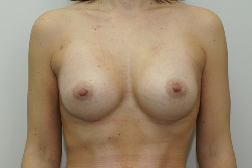 Фото после увеличения груди, пластический хирург Салиджанов Анвар Шухратович