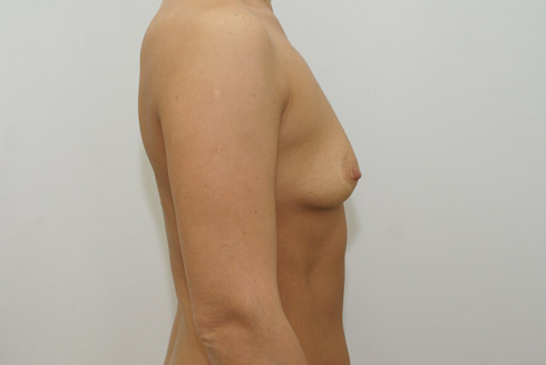 Фото до увеличения груди, пластический хирург Салиджанов Анвар Шухратович