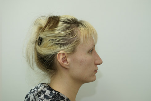 Фото после пластики носа, пластический хирург Салиджанов Анвар Шухратович