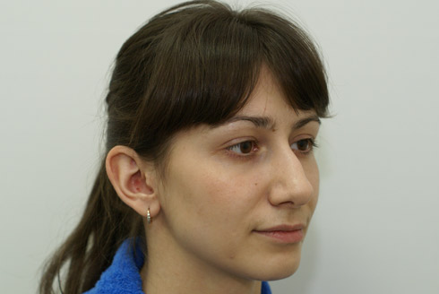 Фото до пластики носа, пластический хирург Салиджанов Анвар Шухратович