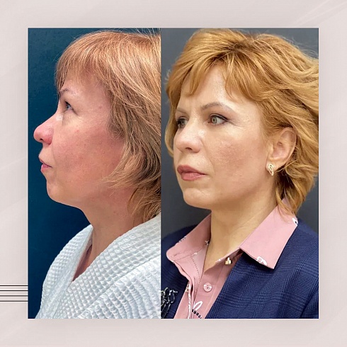 Фото до и после пластики лица, пластический хирург Салиджанов Анвар Шухратович
