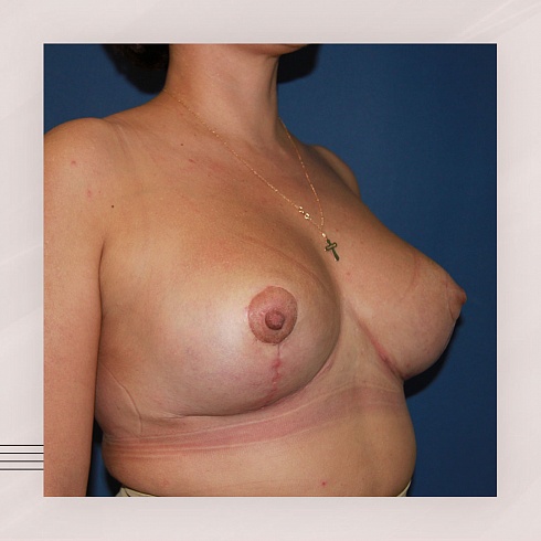 Фото до и после уменьшения груди, пластический хирург Салиджанов Анвар Шухратович