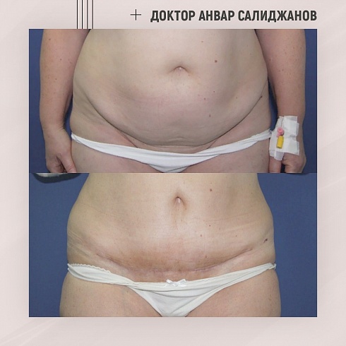 Фото до и после абдоминопластики, пластический хирург Салиджанов Анвар Шухратович