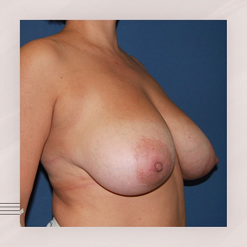 Фото до и после уменьшения груди, пластический хирург Салиджанов Анвар Шухратович