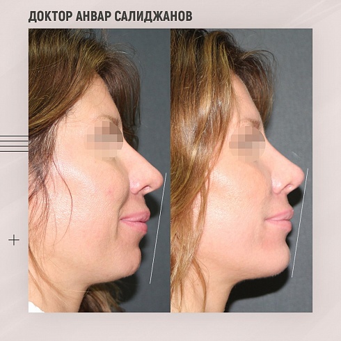 Фото до и после пластики носа, пластический хирург Салиджанов Анвар Шухратович