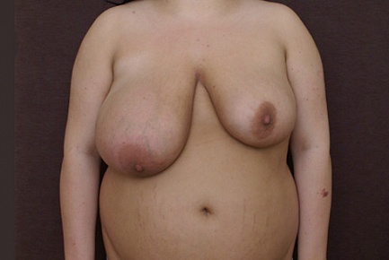 Фото до и после уменьшения груди