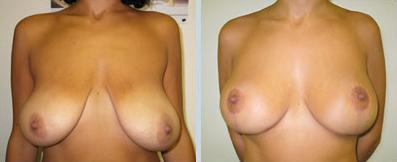 фото до и после подтяжки груди, пластический хирург Салиджанов Анвар Шухратович