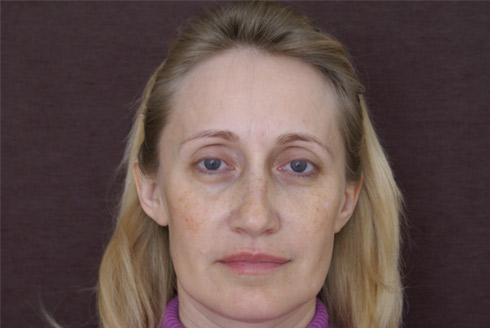 Фото до пластики лица, пластический хирург Салиджанов Анвар Шухратович