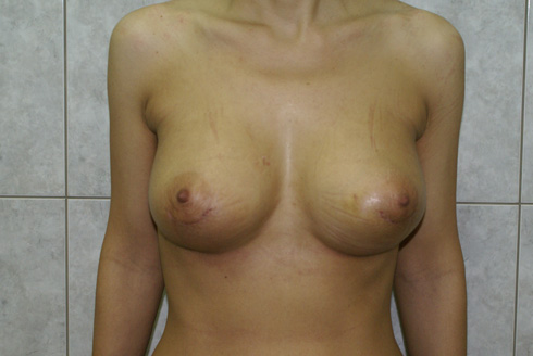 Фото после увеличения груди, пластический хирург Салиджанов Анвар Шухратович
