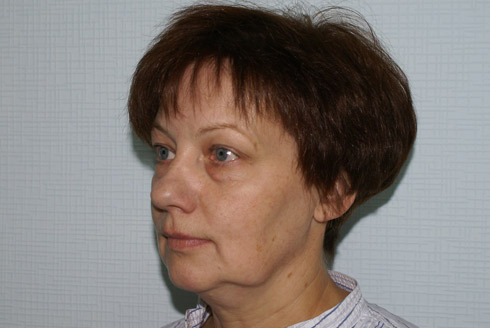 Фото до эндоскопического лифтинга лица, пластический хирург Салиджанов Анвар Шухратович