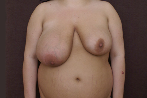 Фото до уменьшения груди и устранения асимметрии, пластический хирург Салиджанов Анвар Шухратович