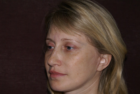 Фото после пластики лица, пластический хирург Салиджанов Анвар Шухратович