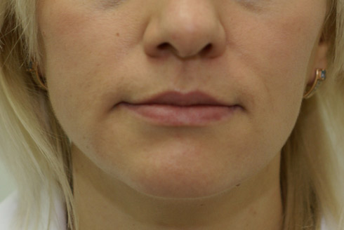Фото до увеличения губ, пластический хирург Салиджанов Анвар Шухратович