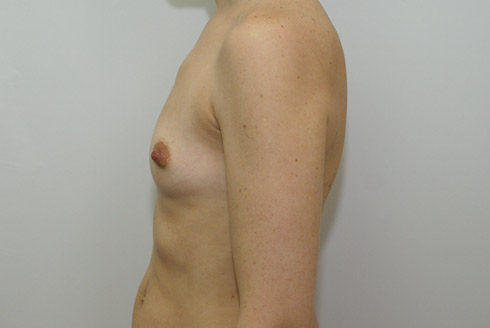 Фото до увеличения груди, пластический хирург Салиджанов Анвар Шухратович