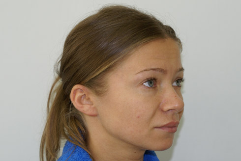 Фото до эндоскопической подтяжки лица, пластический хирург Салиджанов Анвар Шухратович