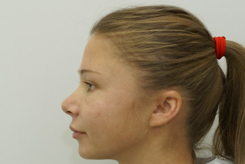 Фото после эндоскопической подтяжки лица, пластический хирург Салиджанов Анвар Шухратович