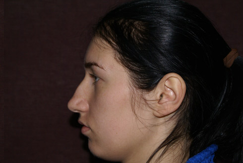 Фото до удаления горбинки на носу, пластический хирург Салиджанов Анвар Шухратович