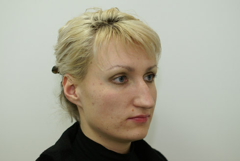 Фото до пластики носа, пластический хирург Салиджанов Анвар Шухратович