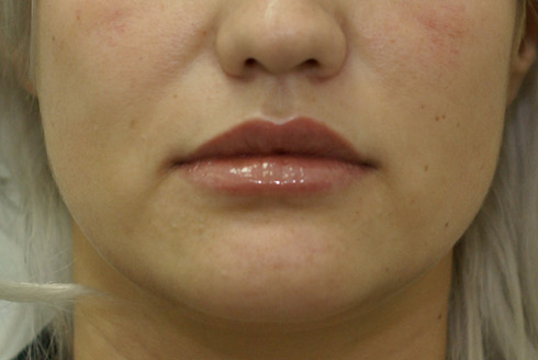 Фото после увеличения губ, пластический хирург Салиджанов Анвар Шухратович