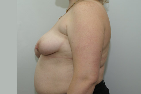 Фото до устранения асимметрии, подтяжки груди, пластический хирург Салиджанов Анвар Шухратович