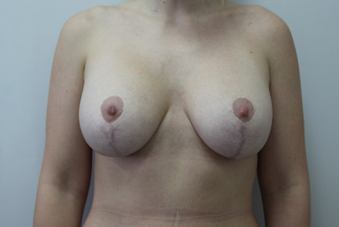 Фото после подтяжки и увеличения груди, пластический хирург Салиджанов Анвар Шухратович