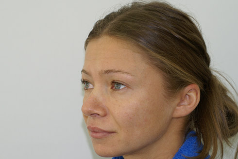 Фото до эндоскопической подтяжки лица, пластический хирург Салиджанов Анвар Шухратович