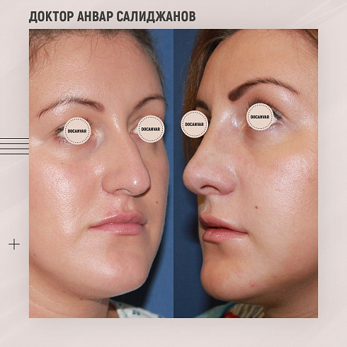 Фото до и после пластики носа, пластический хирург Салиджанов Анвар Шухратович