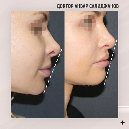 Фото до и после пластики подбородка, пластический хирург Салиджанов Анвар Шухратович