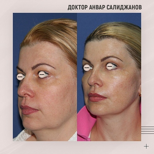 Фото до и после эндоскопической подтяжки лица, пластический хирург Салиджанов Анвар Шухратович