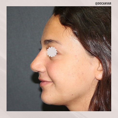 Фото до и после пластики носа, пластический хирург Салиджанов Анвар Шухратович