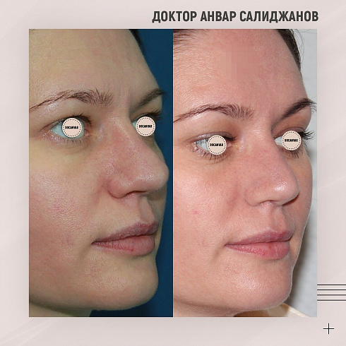 Фото до и после пластики носа, пластический хирург Салиджанов Анвар Шухратович Фото до и после пластики носа, пластический хирург Салиджанов Анвар Шухратович