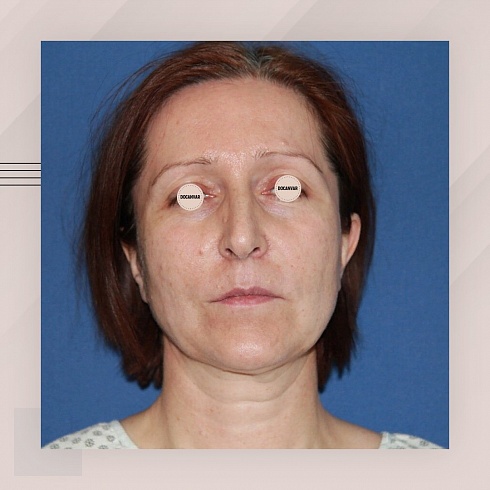 Фото до и после эндоскопической подтяжки лица, пластический хирург Салиджанов Анвар Шухратович
