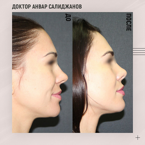 Фото до и после блефаропластики, пластический хирург Салиджанов Анвар Шухратович Фото до и после блефаропластики, пластический хирург Салиджанов Анвар Шухратович