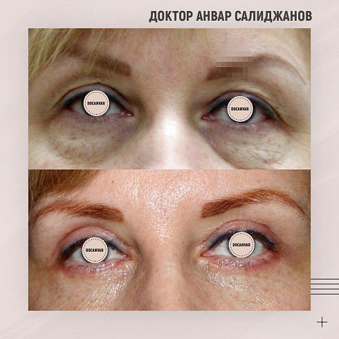 Фото до и после блефаропластики, пластический хирург Салиджанов Анвар Шухратович