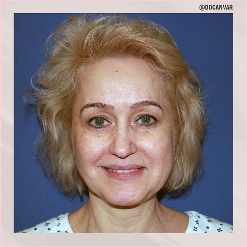 Фото до и после пластики лица, пластический хирург Салиджанов Анвар Шухратович